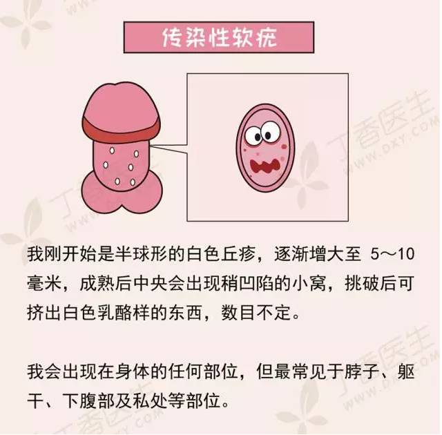 得了尖锐湿疣_得了尖锐湿疣还会得其他的性病吗_女性得了尖锐湿疣又什么症状