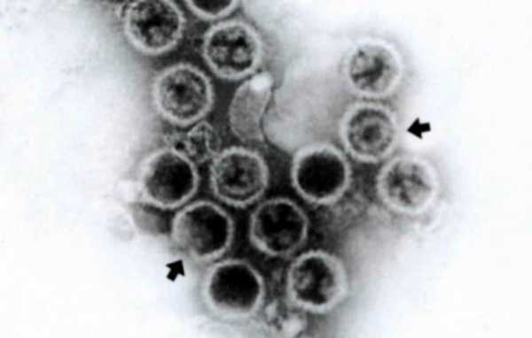 生殖器疱疹怎么根治_生殖器疱疹 根治_生殖器疱疹
