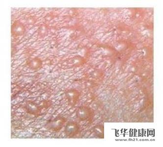 生殖器疱疹_生殖器疱疹 根治_怎样治疗生殖器疱疹