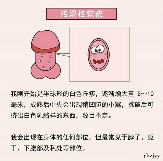 尖锐图片湿疣图片_尖锐湿疣疾病_女性湿疣