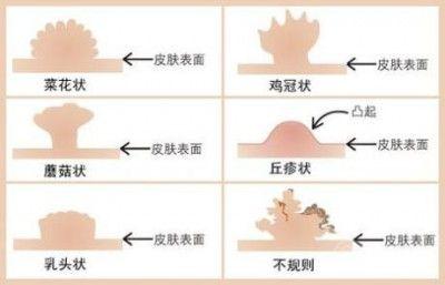 宫颈尖锐湿疣_外阴 宫颈湿疣_宫颈湿疣