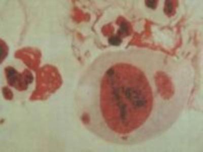 生殖疱疹病毒感染_生殖疱疹如何根治_生殖器疱疹