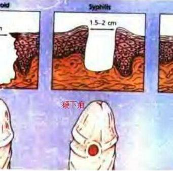 生殖感染疱疹_生殖疱疹病毒感染_生殖器疱疹