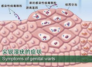 尖锐湿疣_尖利湿疣_尖锐图片湿疣图片