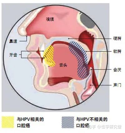 口腔尖锐湿疣