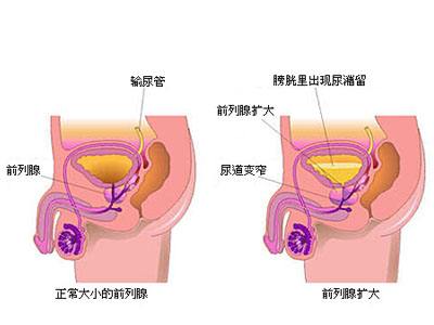 支原体感染为什么难治好