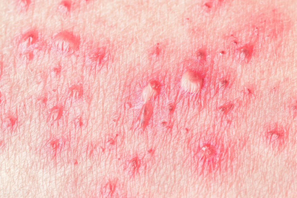 生殖器疱疹是性病吗，如何检查生殖器疱疹
