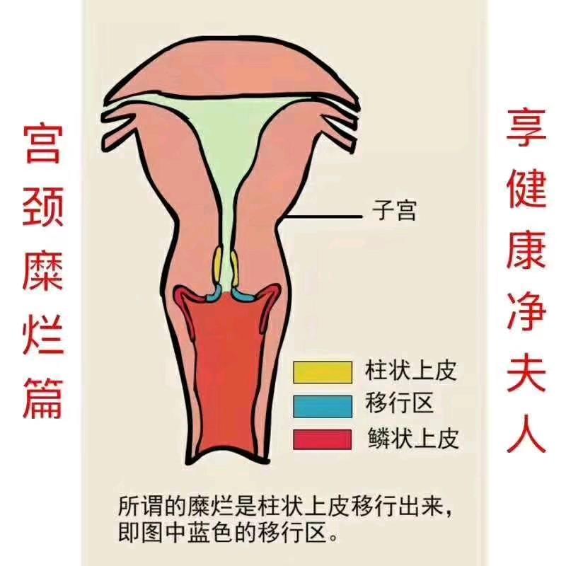 外阴 宫颈湿疣_宫颈为什么会长湿疣_宫颈尖锐湿疣