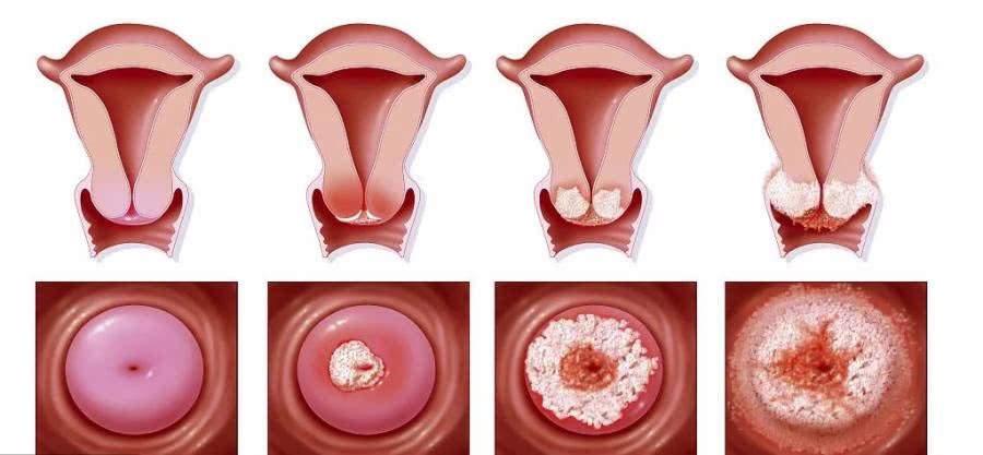 外阴 宫颈湿疣_宫颈尖锐湿疣_宫颈为什么会长湿疣