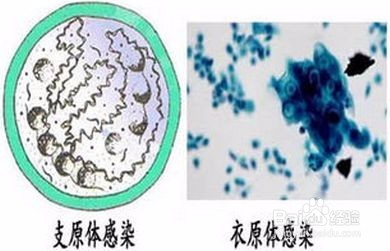 支原体感染