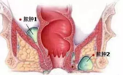 女性淋病的常见早期症状