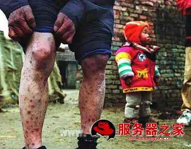 什么是艾滋病呢