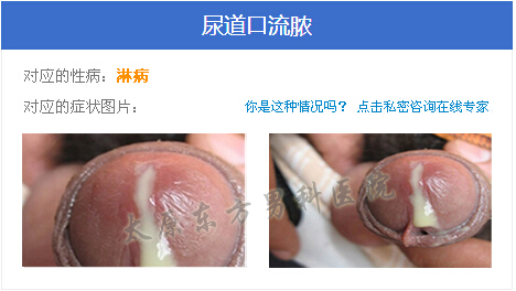 淋病_淋病图片_淋病梅毒