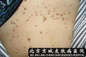 女性尖锐 湿疣的症状_治疗湿疣_尖锐湿疣患者