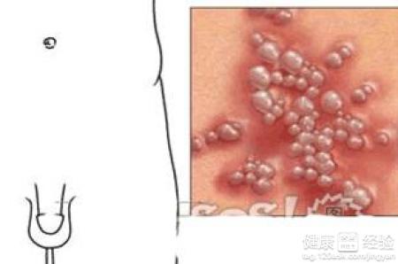 生殖感染疱疹_生殖器疱疹_生殖疱疹治疗的好方法