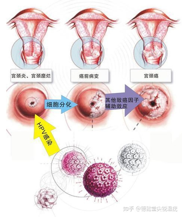 尖锐湿疣患者要注意哪些小常识