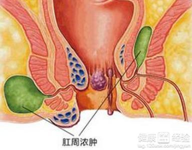 肛门尖锐湿疣_肛门尖锐 疣 图_肛门湿疣