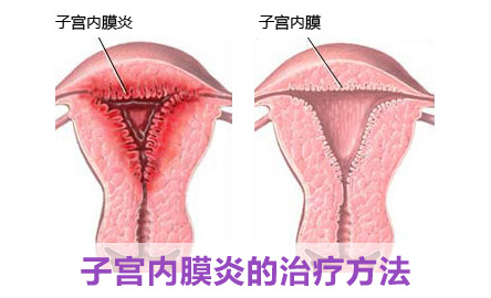 阴道分泌物支原体感染如何治疗 女性支原体怎样治疗最有效