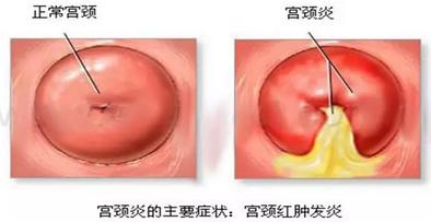 孩子感染支原体的症状_感染支原体的原因_支原体感染