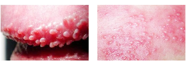 尖锐图片湿疣图片_男性尖锐湿疣_男性假性湿疣与尖锐湿疣的区别