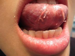 口腔尖锐湿疣_口腔尖锐疣怎么检查_口腔湿疣治疗方法