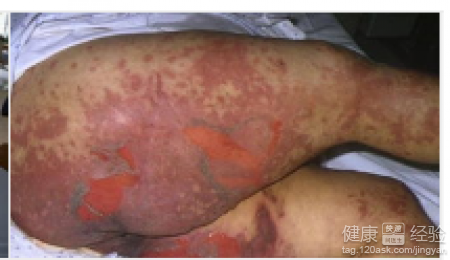 艾滋病的临床表现 艾滋病携带者需要注意什么