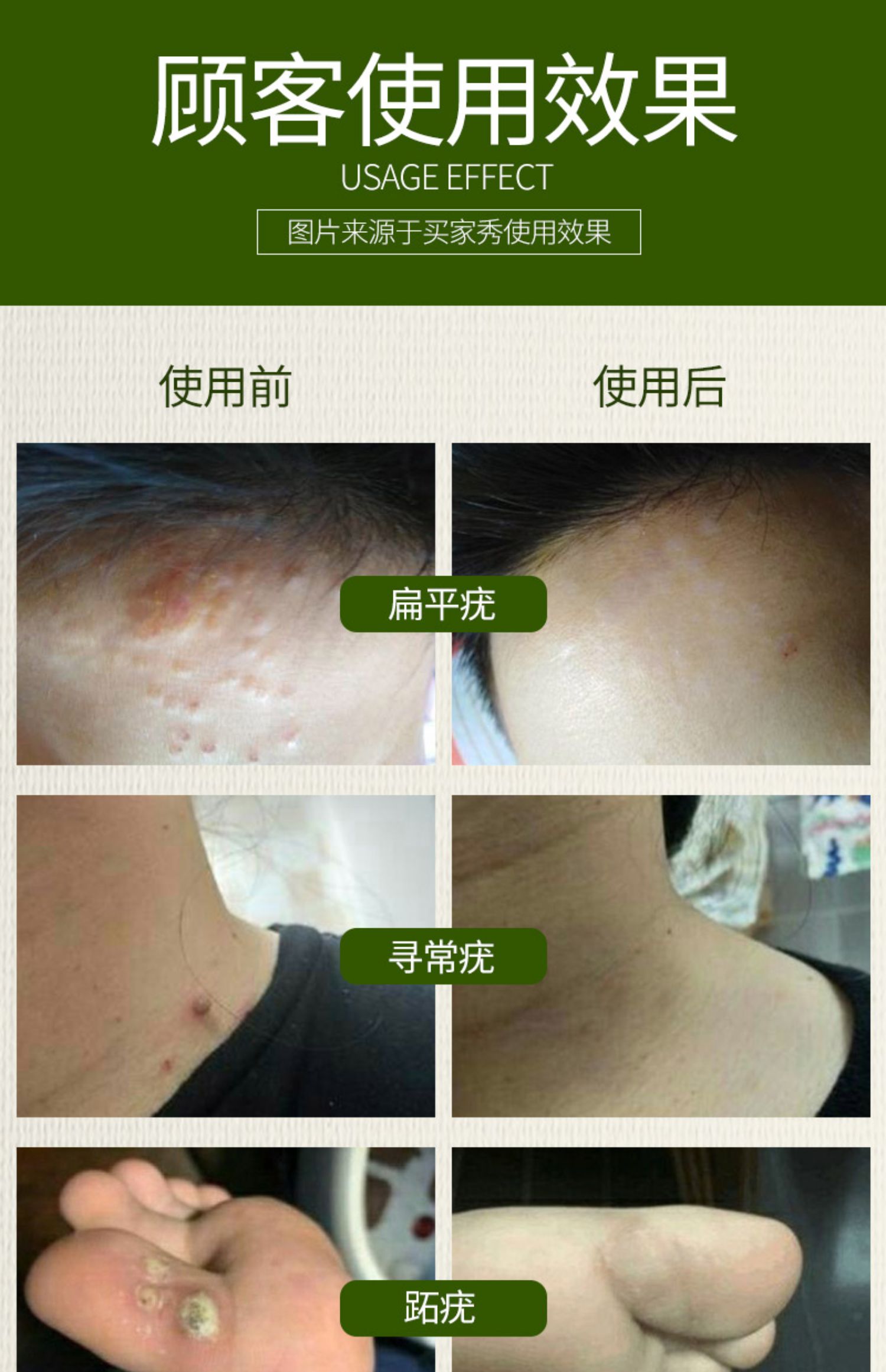 阴道湿疣宫颈湿疣能人工流产吗_女性尖锐 湿疣的症状_尖锐湿疣患者