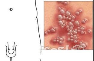 生殖疱疹治疗的好方法_生殖器疱疹_生殖疱疹感染症状
