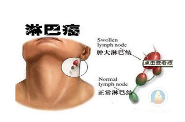 艾滋病治愈