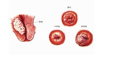 女性支原体阳性感染_支原体感染_感染支原体的原因