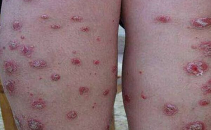 什么是梅毒疹？