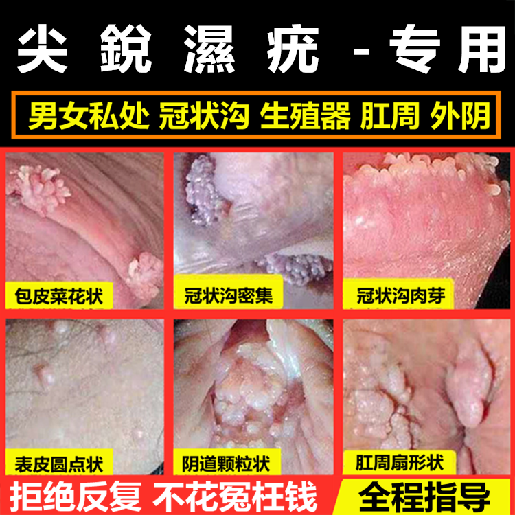 肛门湿疣怎么引起的_肛门尖锐 疣 图_肛门尖锐湿疣