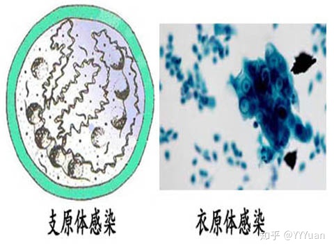 支原体感染