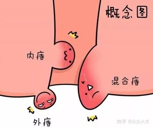 肛门尖锐湿疣