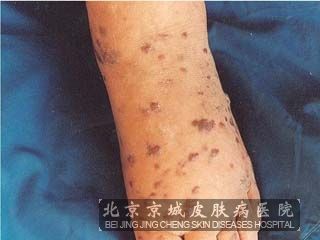 艾滋病有多可怕