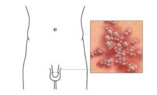 生殖器疱疹反复发作的原因有哪些
