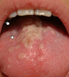 口腔淋病有什么症状