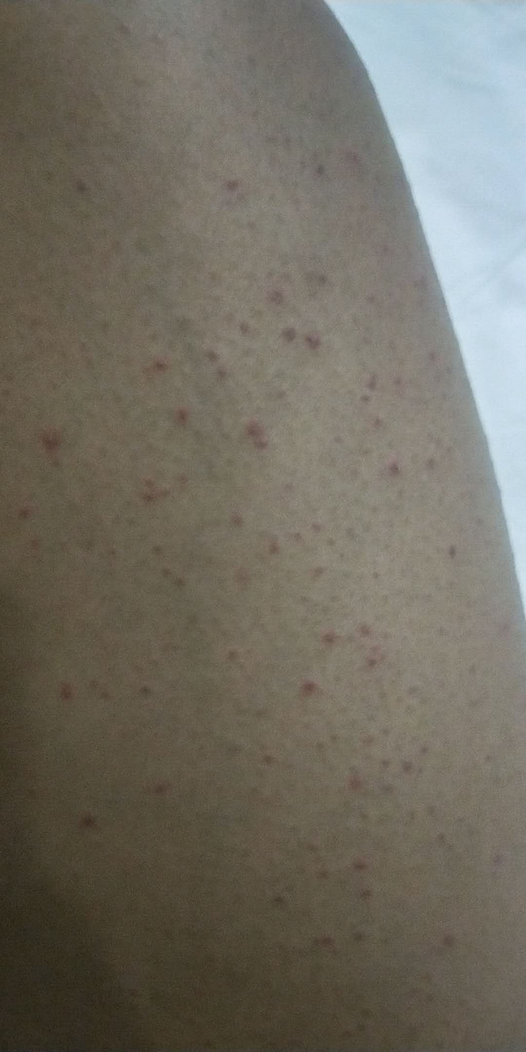 男性艾滋病初期症状表现有哪些