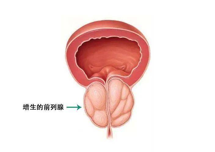 尖锐湿疣严重吗  尖锐湿疣疾病的预防