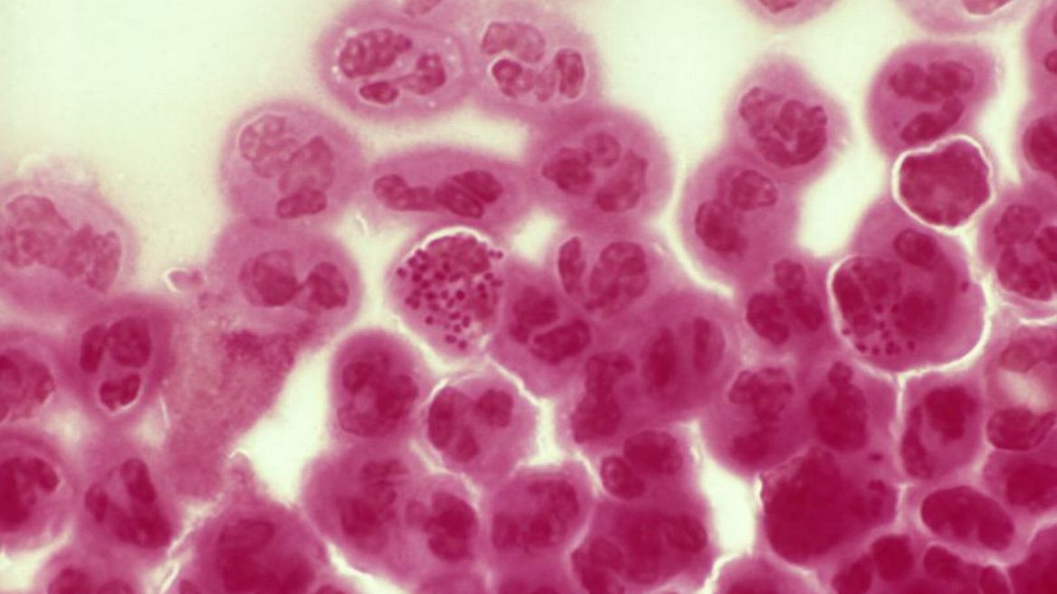 生殖器疱疹症状图片对照