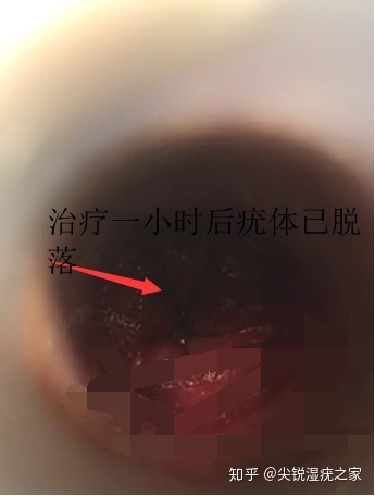 我是如何用咪喹莫特治愈尖锐湿疣（肛内、肛周、阴茎根部大感染）