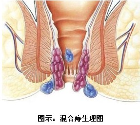 儿童尖锐湿疣的外洗新疗法1例报告