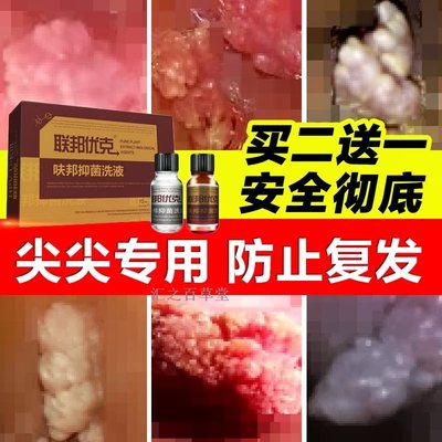 肛门尖锐湿疣_是不是肛门尖锐湿疣