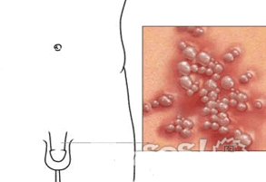 生殖器疱疹的危害有哪些？如何预防生殖器疱疹？