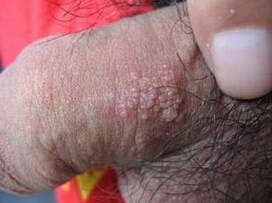 男性生殖器疱疹的症状表现图片