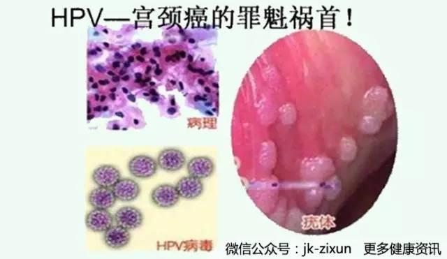肛门尖锐湿疣 HPV在男性中的感染