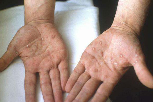 感染梅毒_孕妇感染梅毒_性病科的大夫用手摸了皮肤会感染梅毒吗