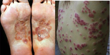 感染梅毒_孕妇感染梅毒_性病科的大夫用手摸了皮肤会感染梅毒吗