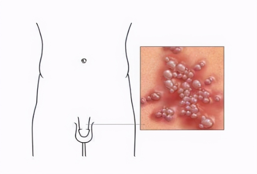 生殖器疱疹能根治吗？