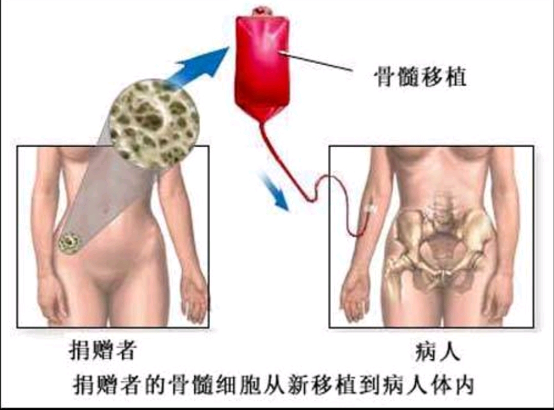 艾滋治愈_有治愈艾滋病的中药吗_艾滋病治愈